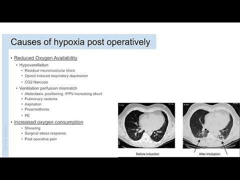 Post Operative Oxygen Therapy | Anaesthesia