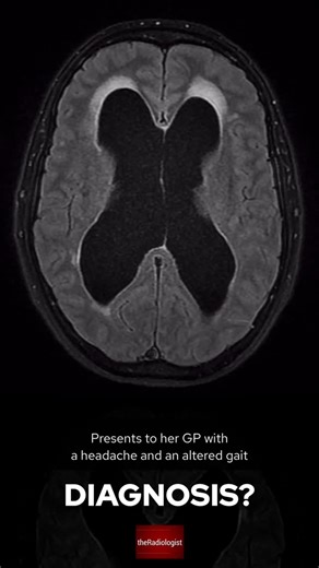 the Radiologist | Radiology | A female in her 50s presents with headache and unsteady gait. What does the scan show? ———————— COLLOID CYST 👨🏽‍💻Here we have a FLAIR... | Instagram