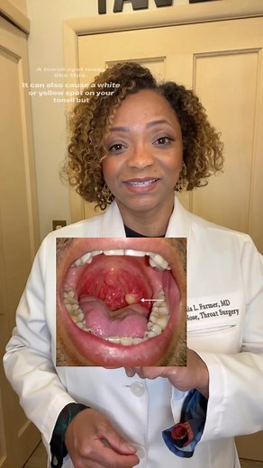 Tonia L. Farmer, MD | Tonsil stones and cysts are common white spots on the tonsils. They look different but can cause similar symptoms. One main difference is... | Instagram