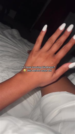 Understanding Tanning Blindness: Signs and Precautions