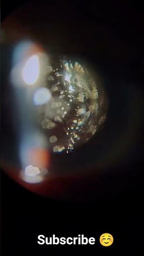 Ever wondered how a cataract looks inside the human eye? 👁️#optometry🥹#science #eye #school#mbbs