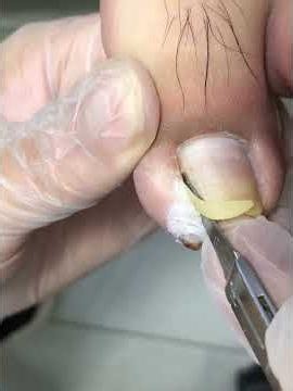 An inflamed ingrown toenail is piercing through the toe! #nails #foot