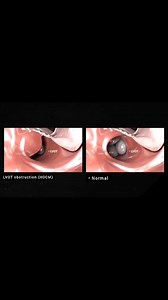 Hypertrophic Cardiomyopathy (HCM) is a genetic condition characterized by the thickening of the heart muscle, particularly the interventricular septum. This thickening can obstruct blood flow from the left ventricle to the aorta, a condition known as Left Ventricular Outflow Tract (LVOT) Obstruction. When this obstruction occurs, it is referred to as Hypertrophic Obstructive Cardiomyopathy (HOCM). Key Features of HOCM: Septal Hypertrophy: The thickening of the septum can impede blood flow, leadi
