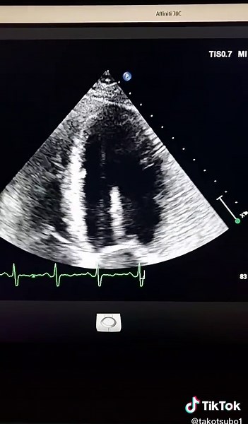 El poder del contraste en ecocardiografía