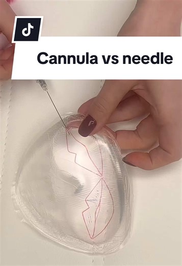 Cannula vs Sharp Needle: Which is Best for Lip Enhancements?