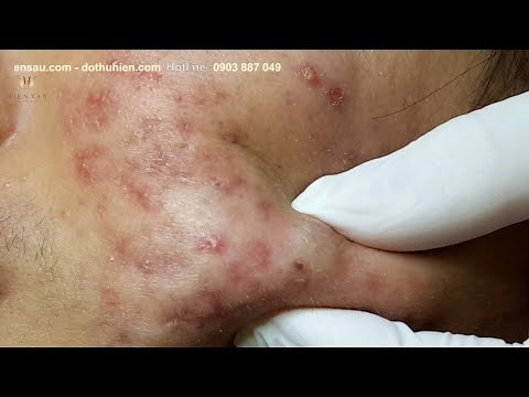 Remove and Clean many Cyst in younger at hien van spa|344|Tiến Hưng