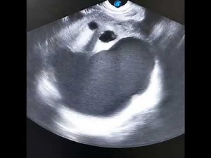 Complex uterine and adenexal masses [?? neoplastic process] ‎@ImagingStudy ‎@radiologytutorials