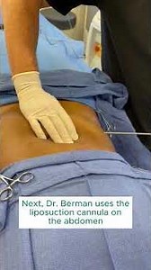 SmartLipo Procedure on Patient's Abdomen