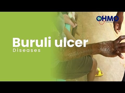 Know More About Buruli Ulcer Disease
