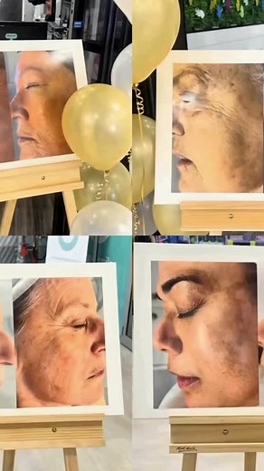 15 years ago, Oi began as a dream, to help people feel confident and beautiful in their own skin. ✨ Today, that dream has grown into a thriving community built on trust, care, and real results. 🖤 We’re endlessly thankful for every person who’s walked through our doors and made Oi what it is today. Your loyalty, your stories, and your smiles are the reason we do what we do. Here’s to you, our incredible Oi Fam and to another 15 years of glowing together. ✨ #skin #skintreatment #skinclinic #goldc