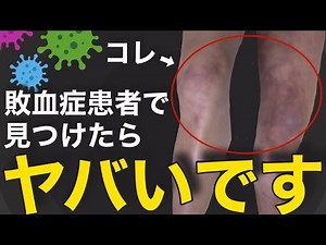 [Caution] If this finding is observed in both knees of a patient with sepsis, it is a dangerous sign
