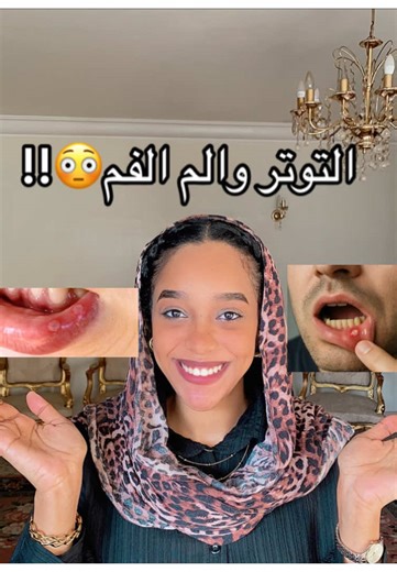 Aphthous ulcer, is a common, non-contagious oral ulcer It appears as a small, round or oval painful ulcer with a white or yellow center and a red halo, usually on non-keratinized oral mucosa such as the lips, cheeks, or floor of the mouth. The exact cause is unknown, but it is commonly associated with stress, trauma, nutritional deficiencies, hormonal changes, and immune system factors. Treatment is mainly symptomatic, focusing on pain relief and reducing inflammation. #dentist #explore #sudanes