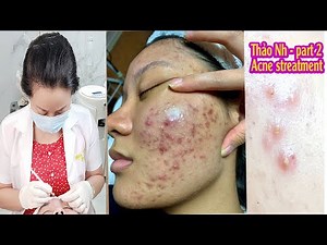 Cyst Acne Treatment | Điều trị mụn hiệu quả số 1 Hiền Vân Spa | Thảo Nhi | Part 2 | 524