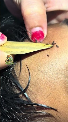 🪳 The Lice Is Back in the Hair!#HeadLice #LiceHunt #liceremoval