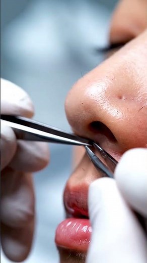 🤯 GIANT Blackhead EXTRACTION! You WON'T Believe What Comes Out! 😱 (Satisfying)