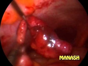 NOTES Using Standard Laparoscopic Instruments • Video • MEDtube.net