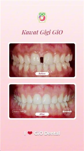 Kawat Gigi Gio | Gigi renggang / Diastema