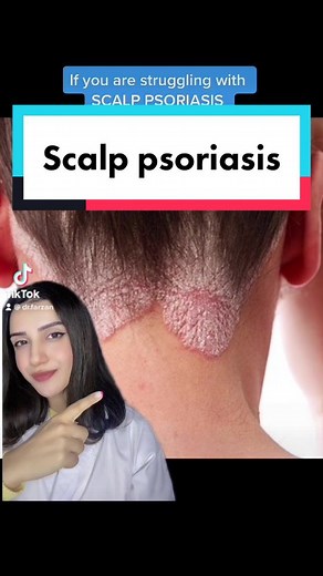 Effective Shampoos for Scalp Psoriasis Treatment