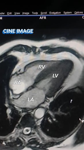 MR cine imaging of cardiac mri was performed on Siemens MAGNETOM Avanto 1.5Tesla Scanner using a dedicated 32 channel phased-array surface coil. | RAHUL GAUTAM