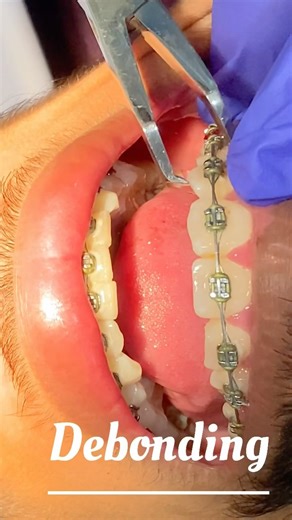 Ortho Brackets removal#debonding#orthodontics #orthodontist #bracket #braces #braceslife #cosmetics