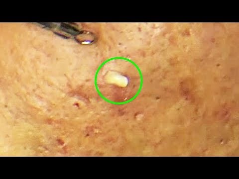 Traitement acné ~ Enlever les boutons points noirs et blancs sur le visage #4