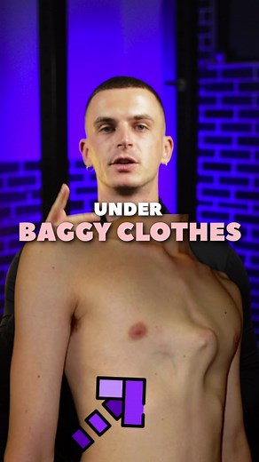 Managing Pectus Carinatum Deformity at Home