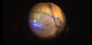 Subluxated IOL Rescue With Sutureless Scleral Fixation - Eyetube