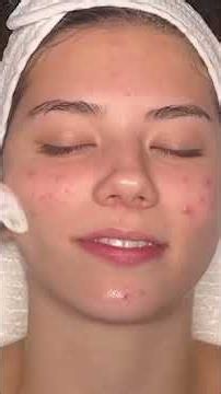 Skincare Peel: Gauging Your Pain Tolerance! #shorts