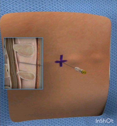 Lumbar puncture #surgery #operation