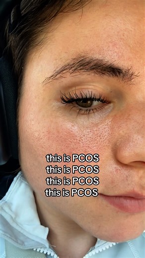 37K reactions · 3.6K shares | PCOS is a chronic hormonal disorder...