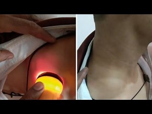 cystic hygroma neck - transillumination test