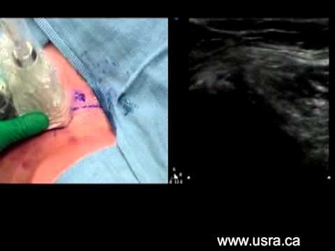 Lateral Femoral Cutaneous Nerve Block - In Plane Approach