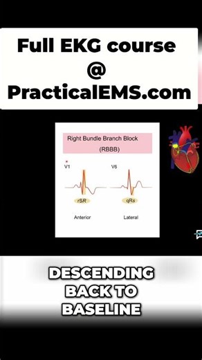 RBBB: Spotting the 'Rabbit Ears' on Your EKG (Easy Guide!) #shorts