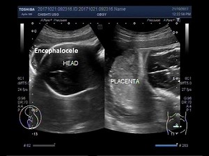 Ultrasound Video showing intrauterine fetal death with positive spalding sign and an encephalocele.