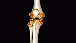 CT Scan of Knee joint 3D rendering showing fracture of lateral...