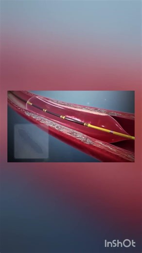 Angioplasty Procedure | Blocked Artery Treatment Without Open Surgery 🫀