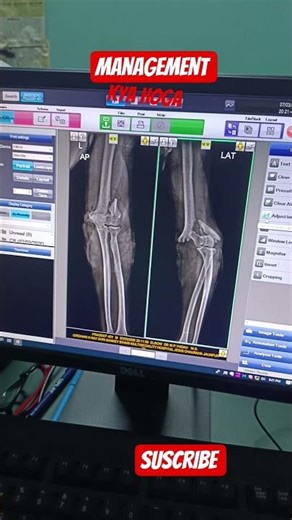 X-Ray ko samjho, diagnosis ko strong banao.”Elbow X-Ray Explained | Norml vs Fracture | supracondyle
