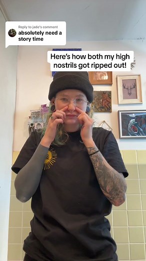 High Nostril Piercing Trauma: A Cautionary Tale