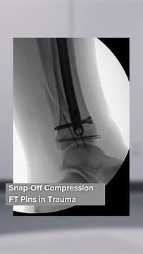 Arthrex Trauma on Instagram: "Erik Kubiak, MD, discusses the benefits and application of Snap-Off Compression FT pins in a trauma setting. Watch the full video at the link in our bio. #Arthrex #Orthopedics #TraumaSurgery #AnkleSurgery #Innovation"