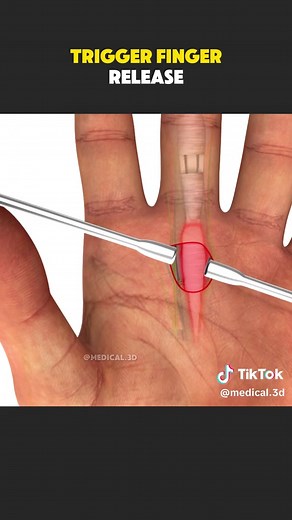 Understanding Trigger Finger Release Surgery Explained