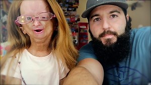 The girl who ages too fast due to progeria