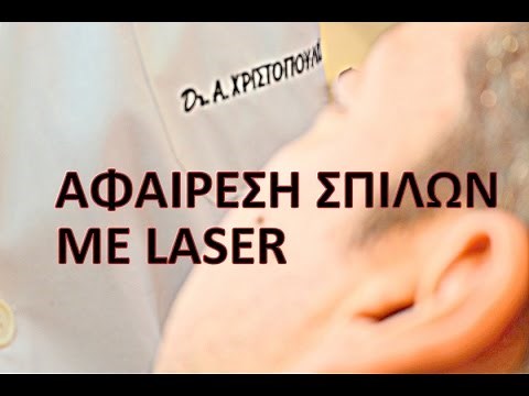 Αφαίρεση σπίλων με laser LIVE