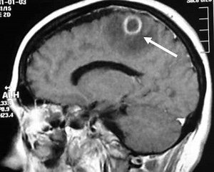 Tratamiento de un Absceso cerebral.