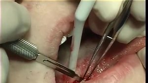 Excisional Biopsy of the Lateral Border of the Tongue