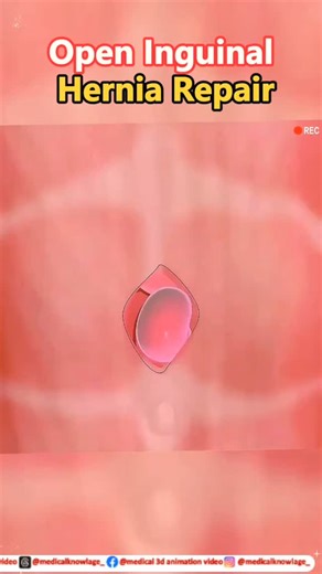 medical knowledge on Instagram: "Open Inguinal Hernia Repair – 3D Explained See how anatomy, incision, and mesh placement come together step by step. Perfect for students, surgeons, and curious minds. #InguinalHernia #HerniaRepair #GeneralSurgery #SurgicalEducation #MedicalAnimation #3DMedical #SurgeryExplained #MedicalReels #MedEd #Anatomy3D #HealthcareContent"