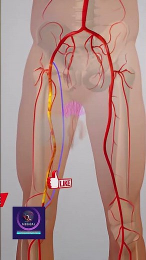 Peripheral Artery Bypass Surgery