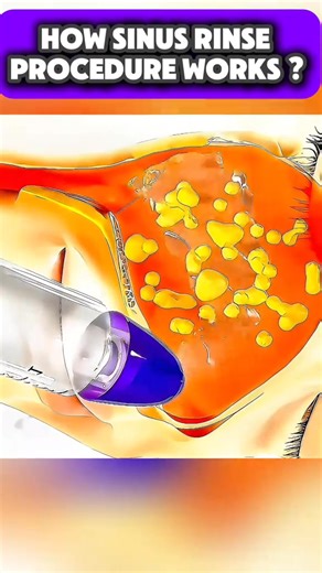 Sinus rinse: A simple, soothing solution to clear your nose, relieve congestion, and help you breathe better—naturally. #SinusRinse #NasalIrrigation #ClearSinuses #BreatheBetter #CongestionRelief #SinusRelief #AllergyRelief #NasalCare #SinusFlush #ENTCare #MedicalEducation #DoctorExplains #HealthTips #WellnessRoutine #NaturalRelief #HealthyBreathing #PublicAwareness #CleanSinuses #NasalHealth #SinusTreatment | Madical World 3D