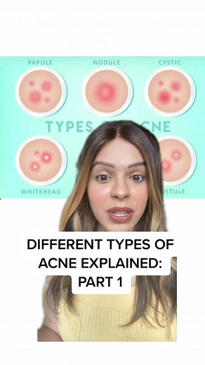 Understanding Different Types of Acne and How to Treat Whiteheads