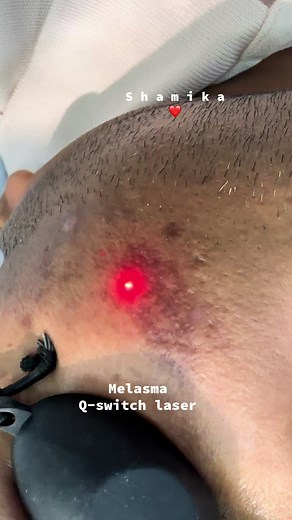 #laser #co2 #whitening #foryoupage #prptreatment #melasma #smoothiebowl #prp #wjiteming#melasmaskincare