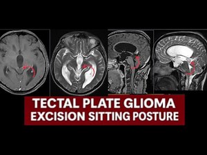 Brain Stem Glioma Surgery:Precision Excision in Sitting Position Using Neuronavigation:Brain surge